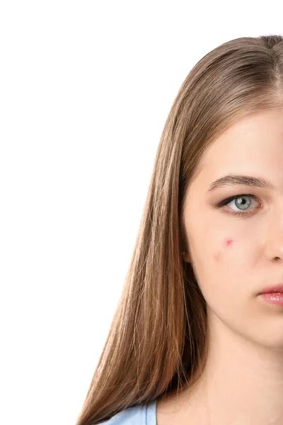 Adolescente Avec Problème Acné Sur Fond Blanc — Photo