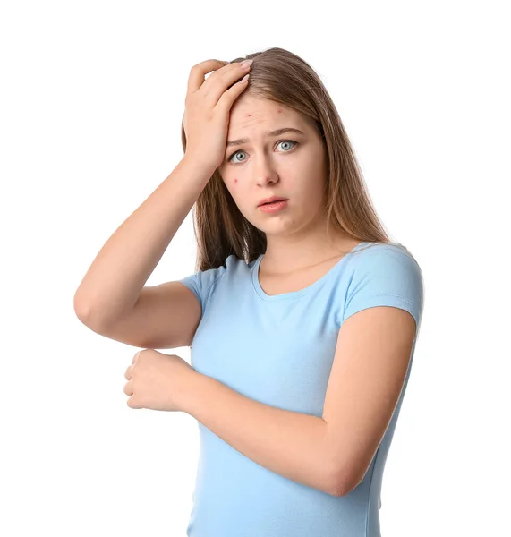 Teenage Girl Acne Problem White Background — Stock Photo, Image