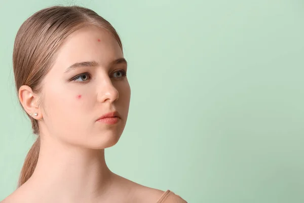 Teenage Girl Acne Problem Color Background — Stock Photo, Image