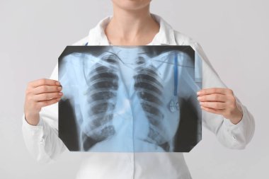 Gri arka planda akciğer röntgeni olan kadın doktor.
