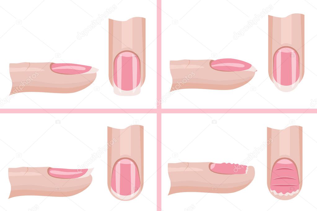 Nail care. Types of the nail plate. Illustration for the manicure guide. Hand nail care .Vector