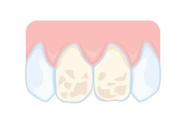 Stomatologia Uszkodzona Emalia Przednich Zębów Problemy Zębami Ilustracja Materiałów Dydaktycznych — Wektor stockowy