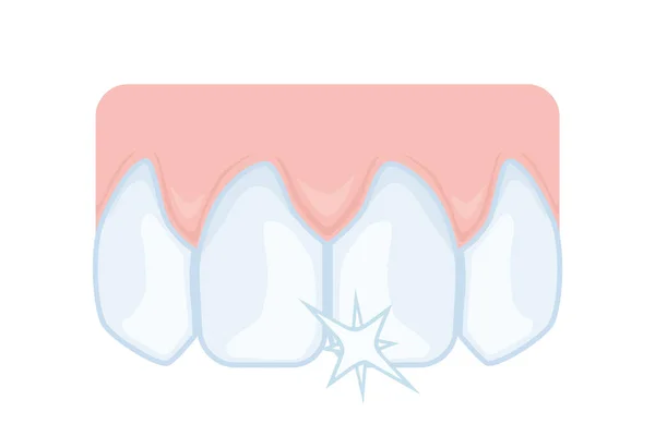 Dientes Frontales Superiores Incisivos Odontología Cuidado Dental Ilustración Para Guía — Archivo Imágenes Vectoriales