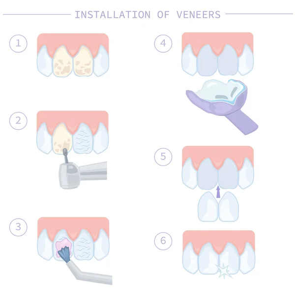 Dental Treatment Care Installation Veneers Stages Work Instructions Dentists Illustration — Stock Vector