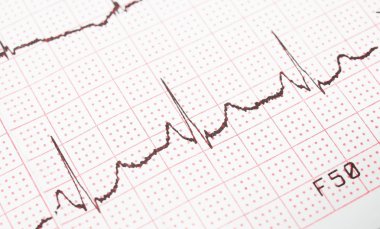 Elektrokardiyogram, EKG çıktı, Ekg arka plan