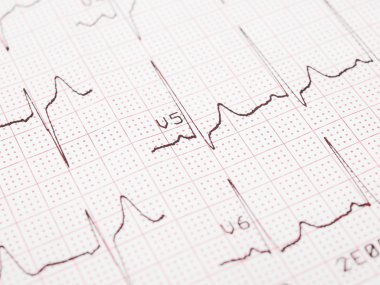 Elektrokardiyogram, EKG çıktı, Ekg arka plan