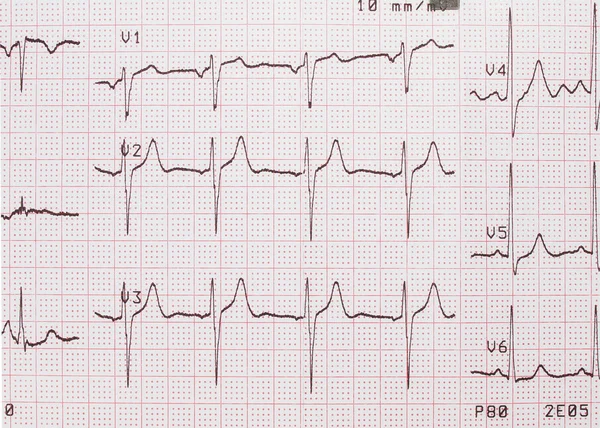 EKG, EKG nyomat, Ekg háttér — Stock Fotó