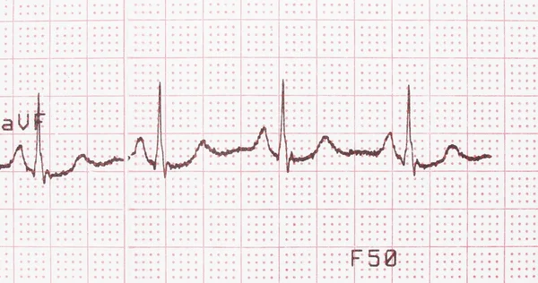 Eletrocardiograma, impressão do ECG, fundo do ECG — Fotografia de Stock