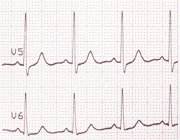 Électrocardiogramme, impression ECG, fond EKG — Photo