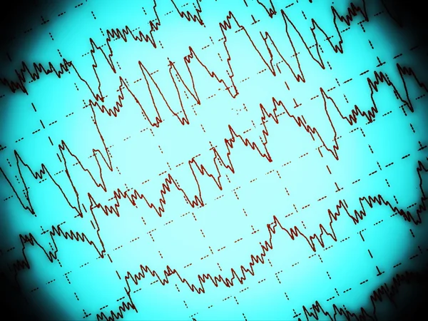 Onda cerebral no eletroencefalograma EEG para epilepsia — Fotografia de Stock