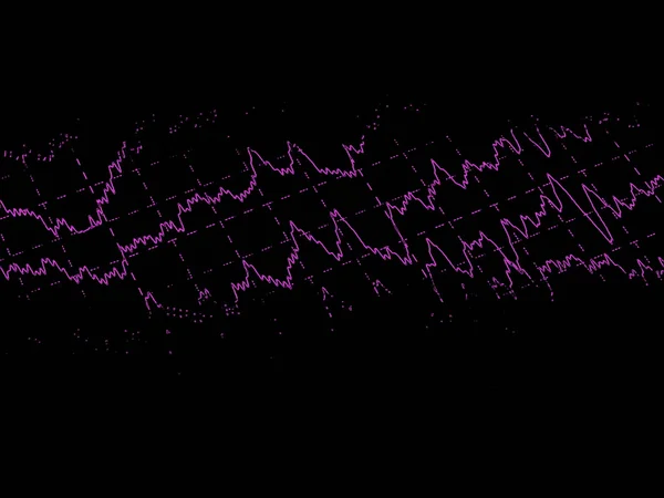 Gehirnwelle auf Elektroenzephalogramm bei Epilepsie — Stockfoto