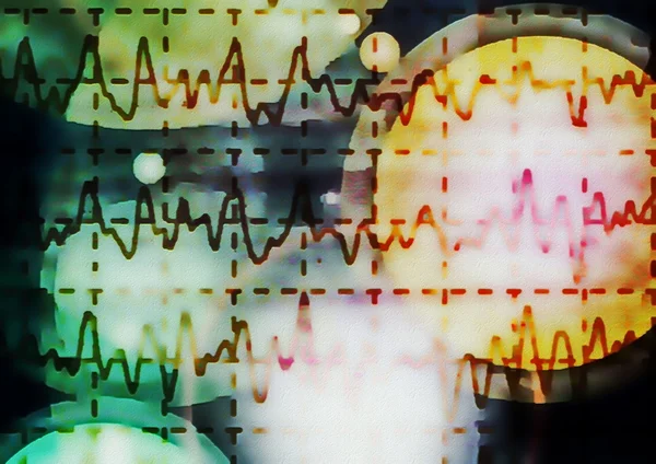 Brain wave on electroencephalogram EEG for epilepsy, illustration — Stock Photo, Image