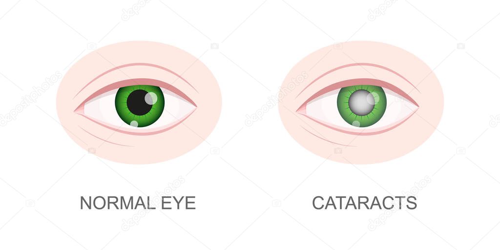 Healthy and cataract eye closeup view. Eyeball with normal and cloudy lens. Anatomically accurate human organ of vision. Vector cartoon illustration