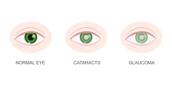 건강하고 백 내장 이 있고 녹내장 이 있는 눈이 감겨져 있다. 정상적 이고 불건전 한 렌즈를 가진 안구. 시각적 문제의 오래 된 개념. 해부학적으로 인간의 시각 기관이죠. 반사기 만화 삽화 — 스톡 벡터