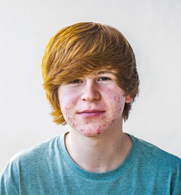 smart boy in puberty with acne clipart