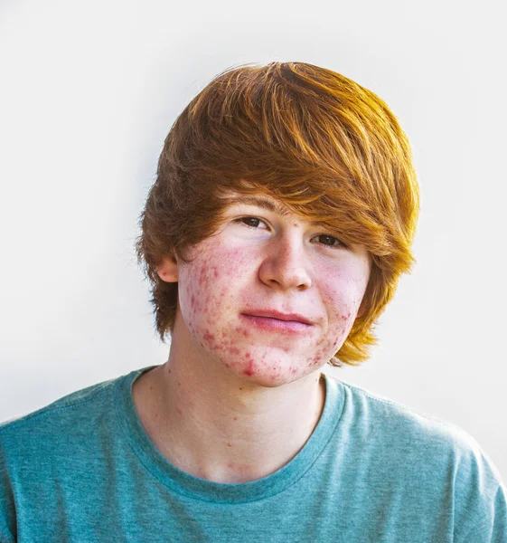 Intelligente ragazzo in pubertà con acne — Foto Stock