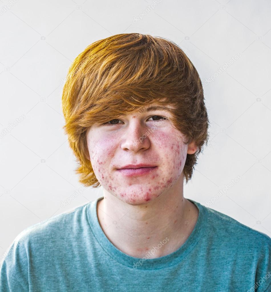 smart boy in puberty with acne