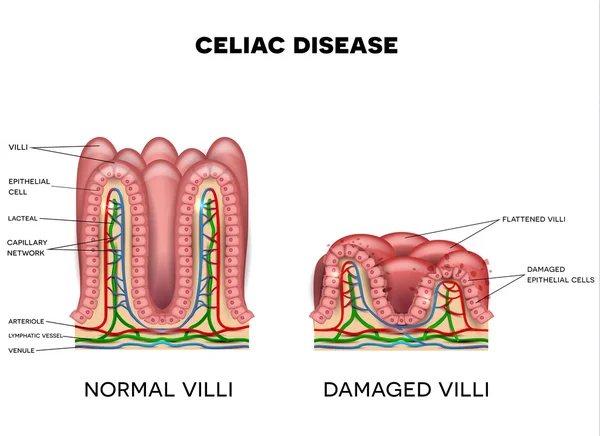 Celiac disease affected small intestine villi — Stock Vector