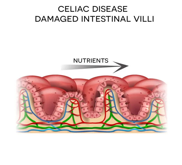 Enfermedad celíaca afectada vellosidades del intestino delgado — Archivo Imágenes Vectoriales