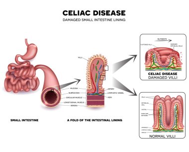 Celiac disease detailed diagram clipart
