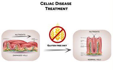 Celiac disease treatment gluten free diet clipart