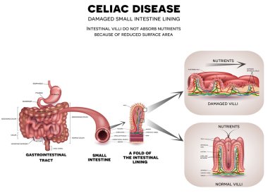 Celiac disease illustration clipart