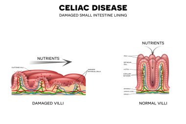 Celiac disease affected intestinal villi clipart