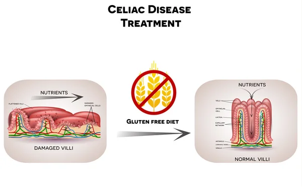 Tratamento da doença celíaca dieta sem glúten — Vetor de Stock