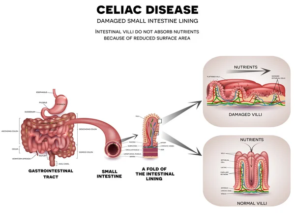 Celiac disease illustration — Stock Vector