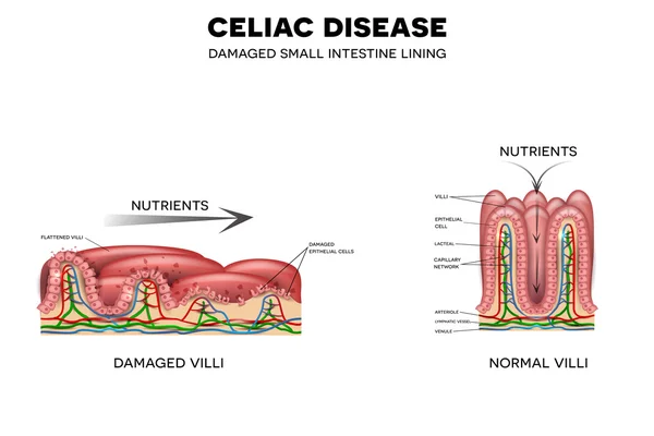 Enfermedad celíaca afectada vellosidades intestinales — Archivo Imágenes Vectoriales
