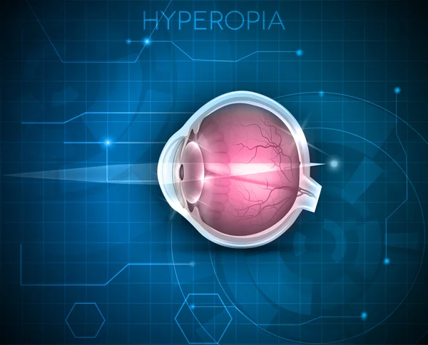 Hyperopia, vision disorder on a blue technology background — Stock Vector