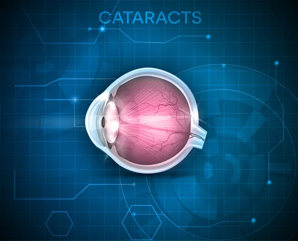 Cataractes, troubles de la vision, anatomie détaillée — Image vectorielle