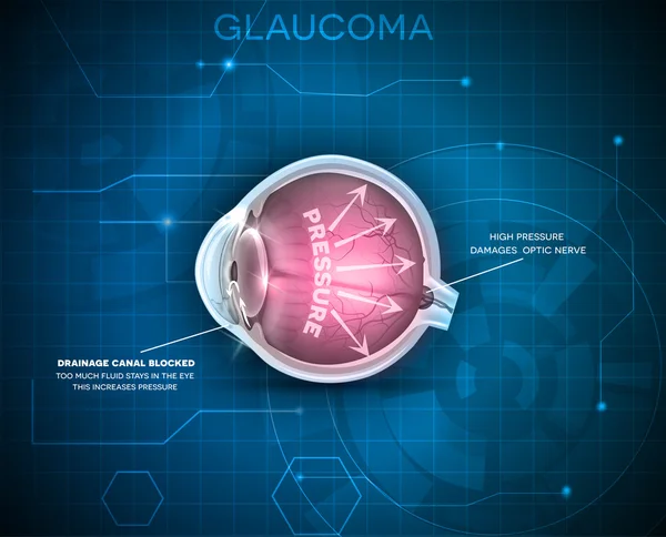 Glaucoom, visie stoornis — Stockvector