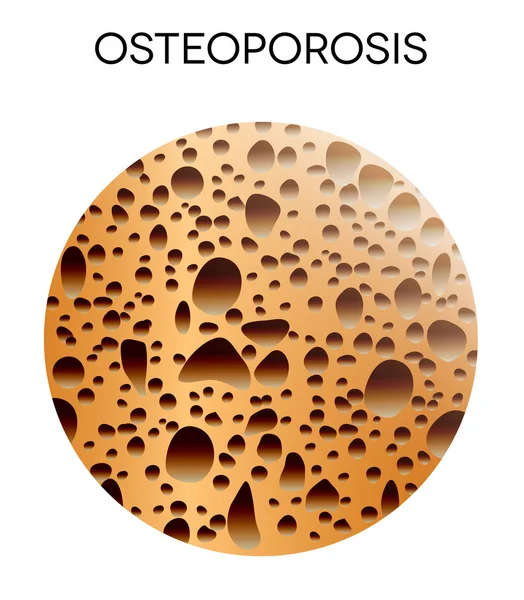 Insan kemik hastalığı-Osteoporoz — Stok Vektör