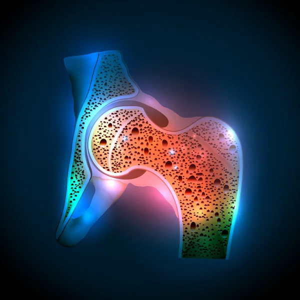 Articulação do quadril humano e osteoporose — Vetor de Stock