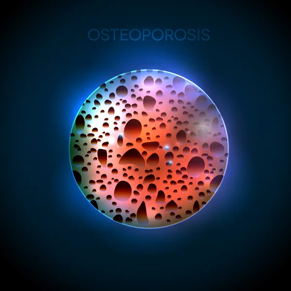 Osteoporosis round illustration on a abstract blue background — Stock Illustration Osteoporosis round illustration on a abstract blue background Stock Vector
