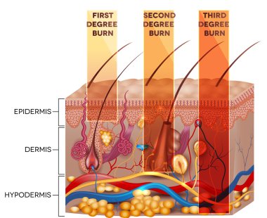 Skin burn classification clipart