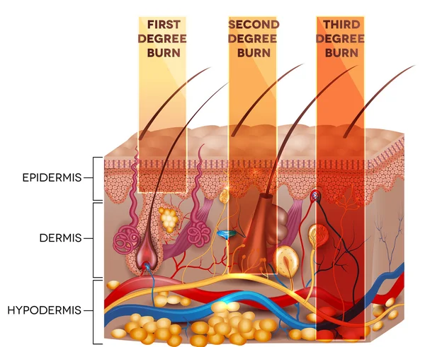 Skin burn classification — Stock Vector