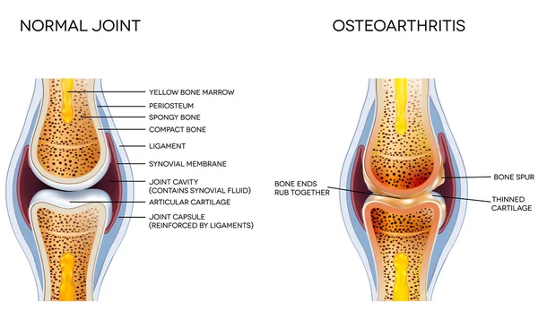 Osteoartrite e anatomia articular normal —  Vetores de Stock