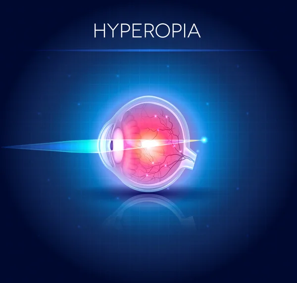 Hyperopia eyesight disorder — Stock Vector