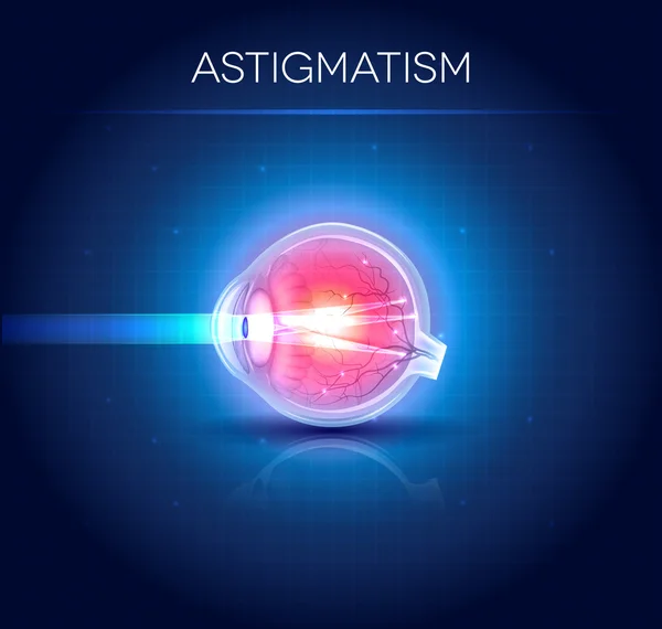 Astigmatismo, distúrbio da visão. Anatomia do olho, secção transversal —  Vetores de Stock