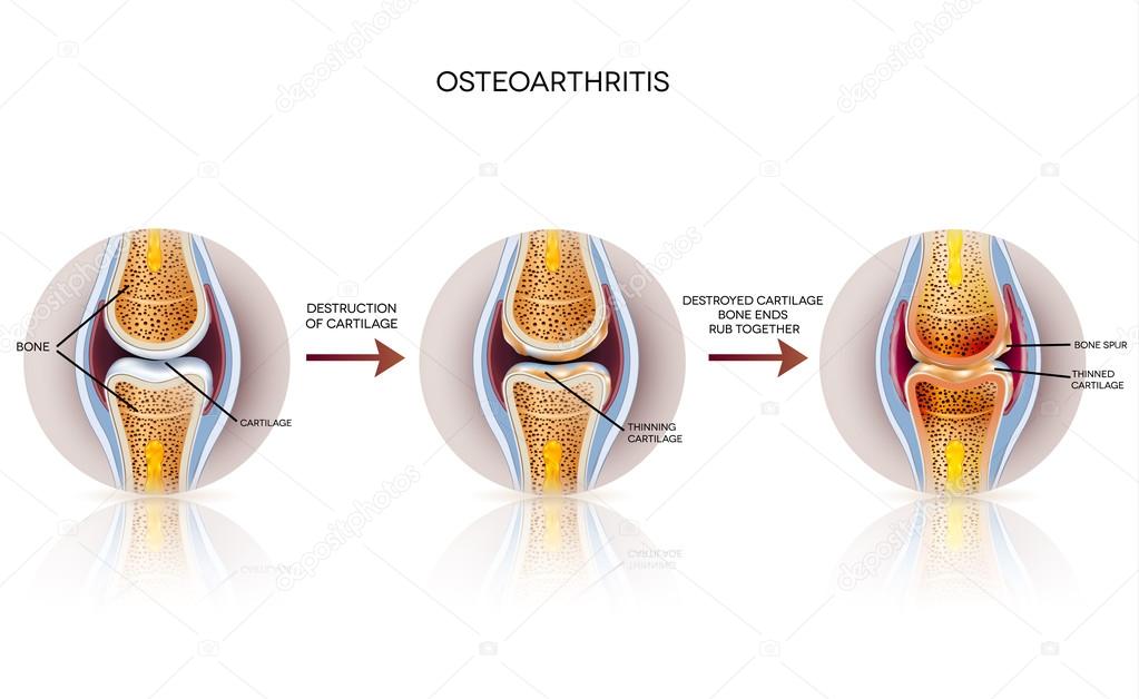 Osteoarthritis detailed illustrations