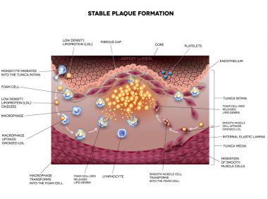 Stable plaque, Atherosclerosis clipart