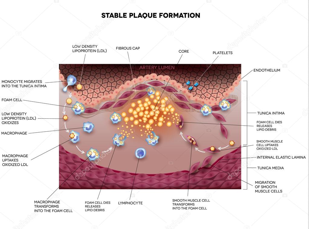 Stable plaque, Atherosclerosis