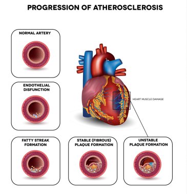 ateroskleroz