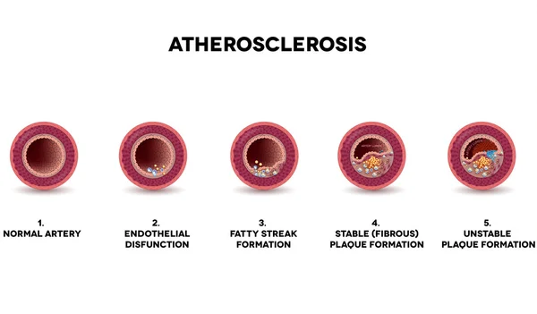 Atherosclerosis formation — Stock Vector