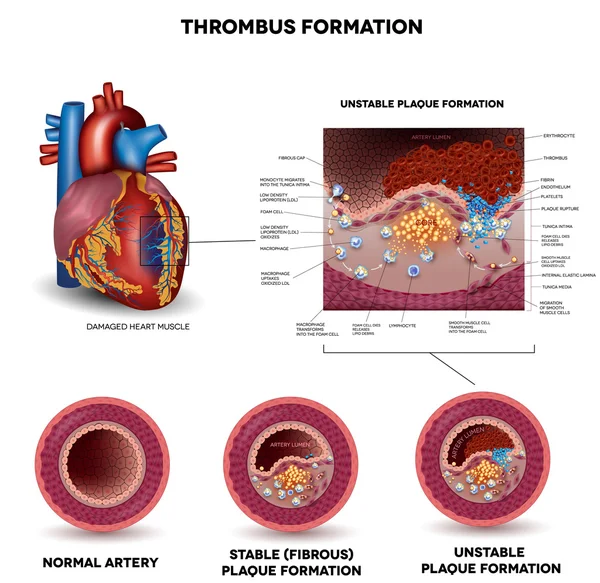 Blood clot formation — Stock Vector