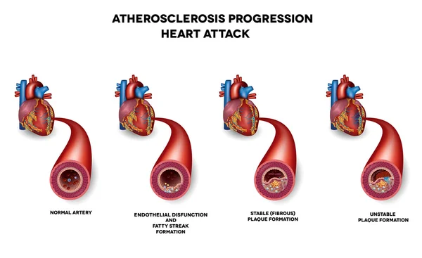 Ataque cardíaco, Aterosclerose —  Vetores de Stock