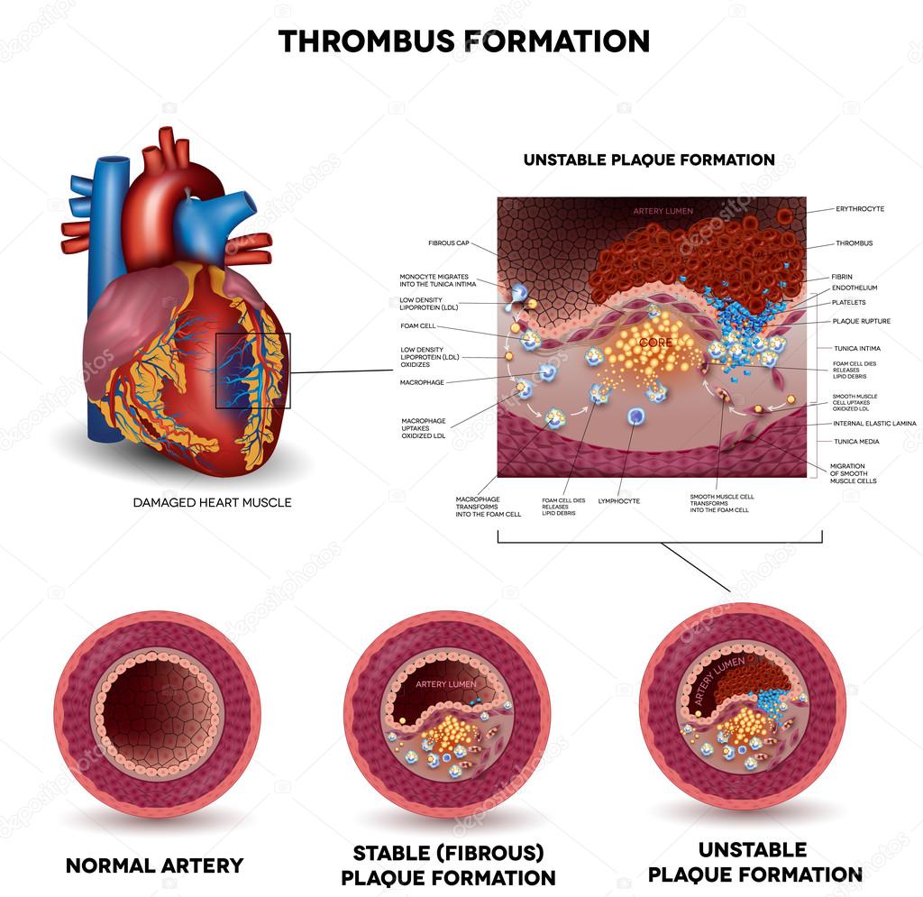 Blood clot formation