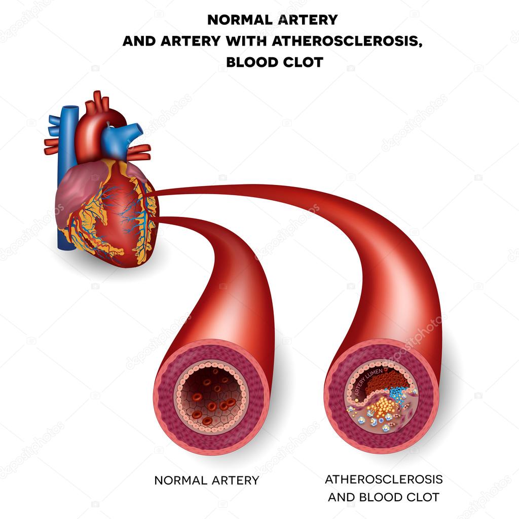 Normal artery and unhealthy artery with blood clot